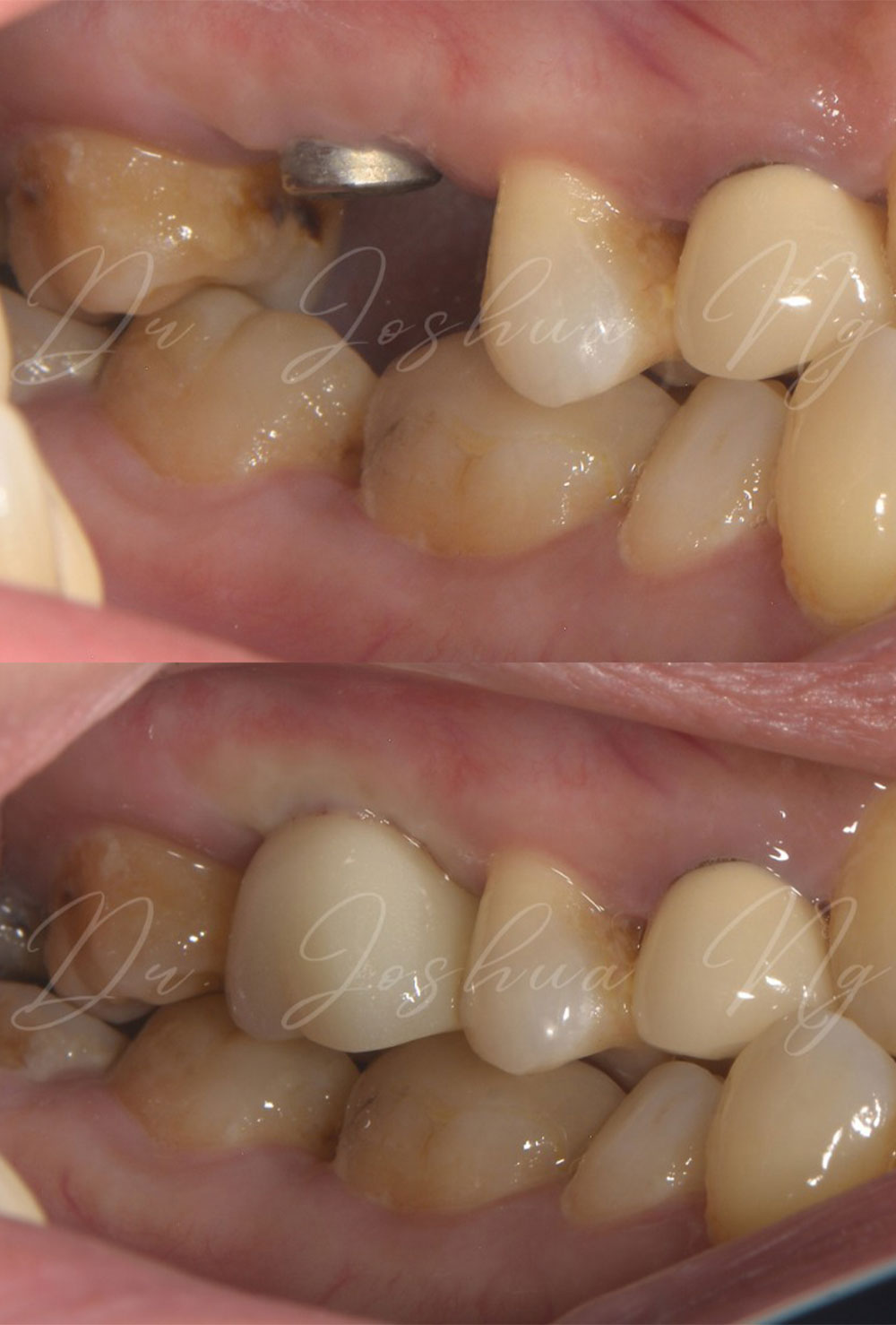 Dental Implant Before & After