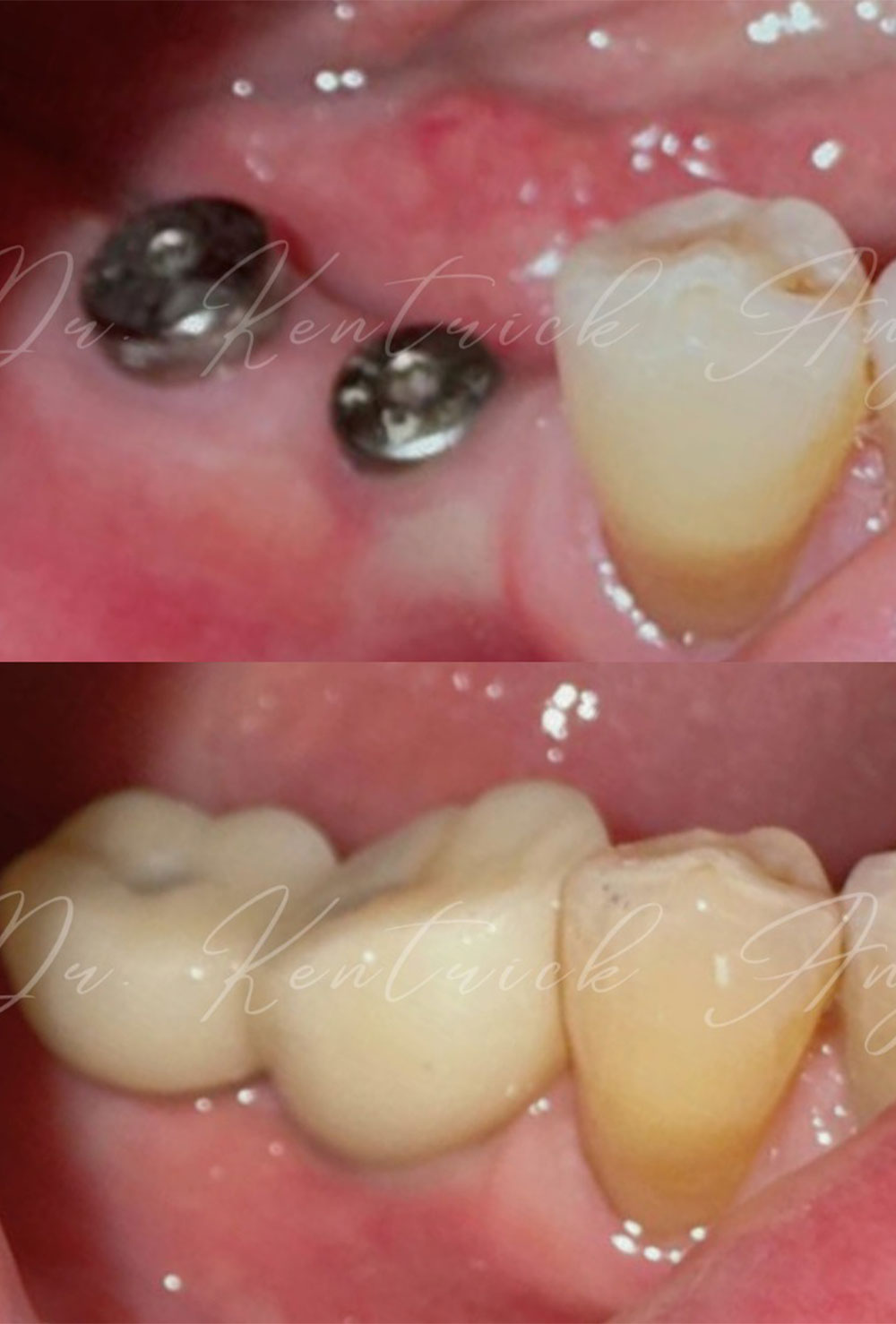 Dental Implant Before & After