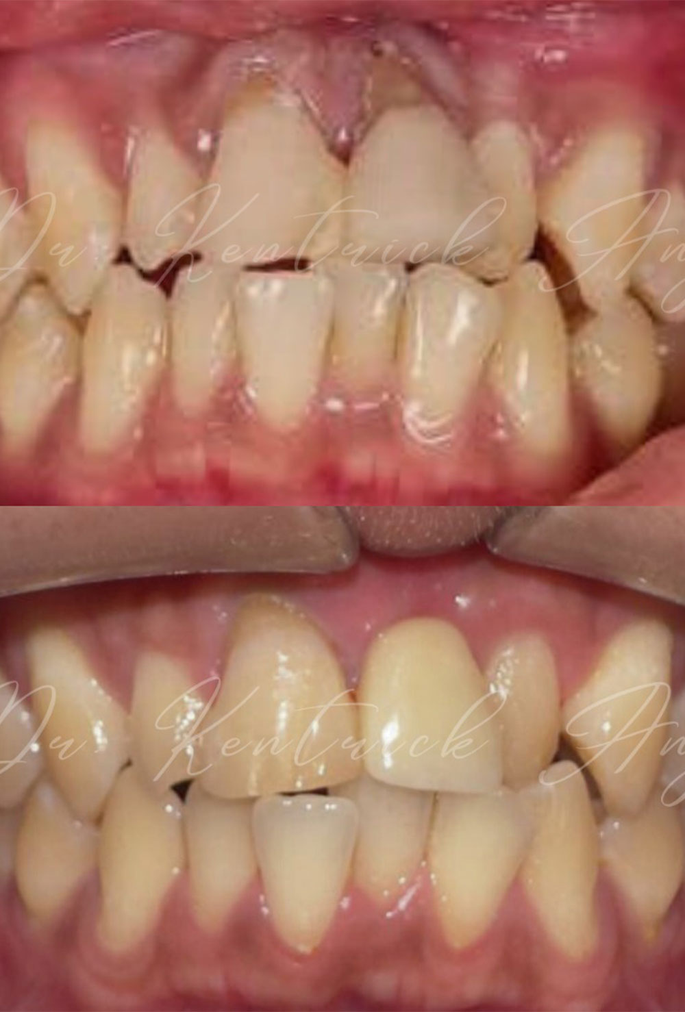 Dental Implant Before & After