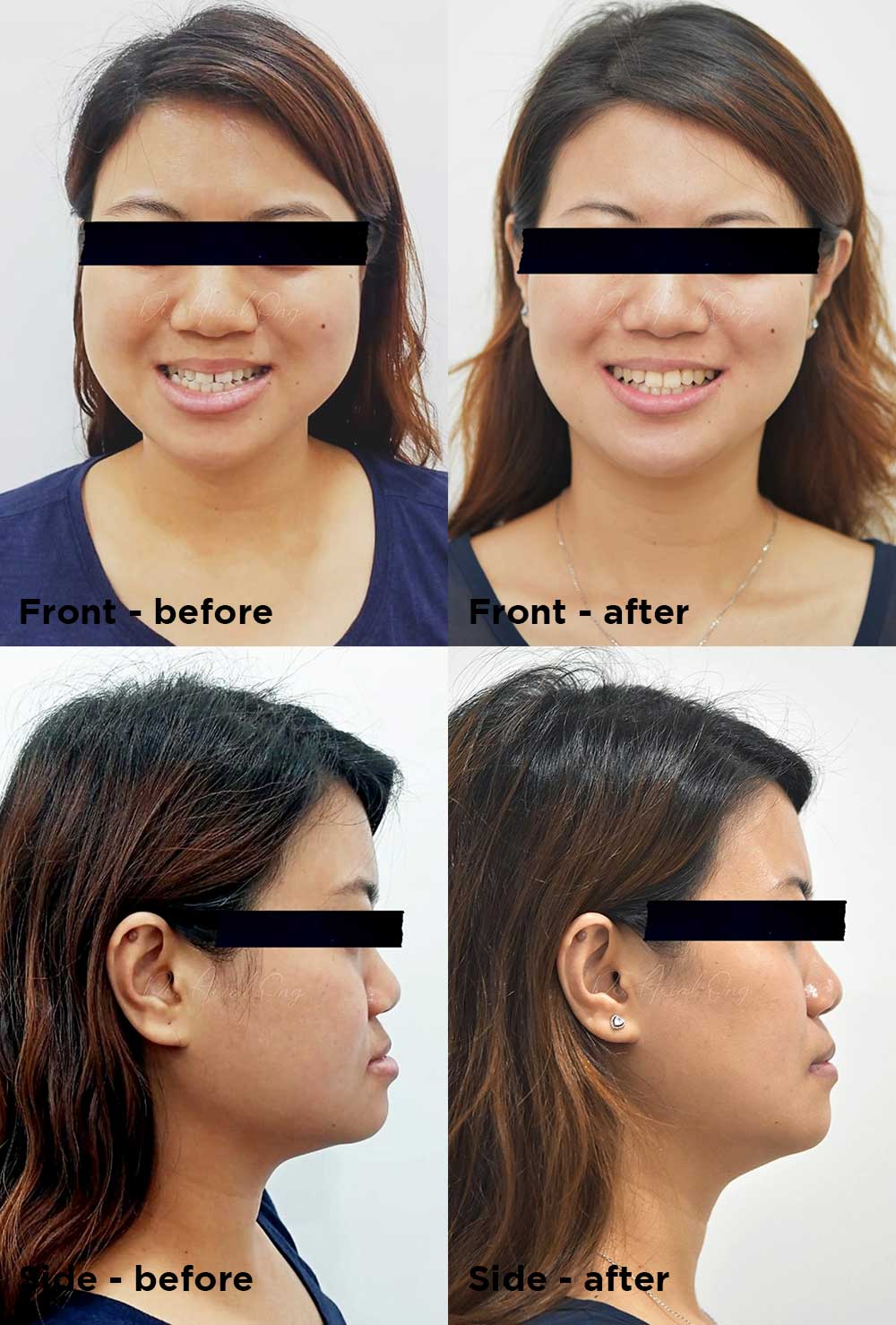 Smile Assessment Before & After
