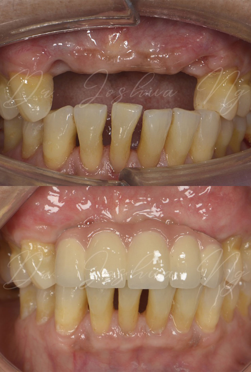 Dental Implant Before & After