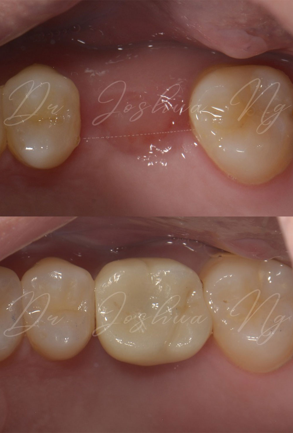 Dental Implant Before & After