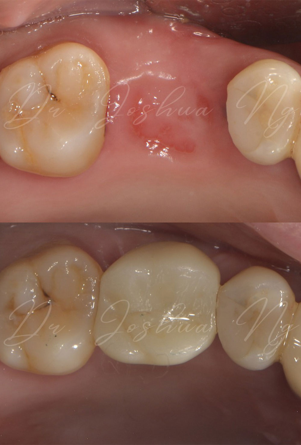 Dental Implant Before & After