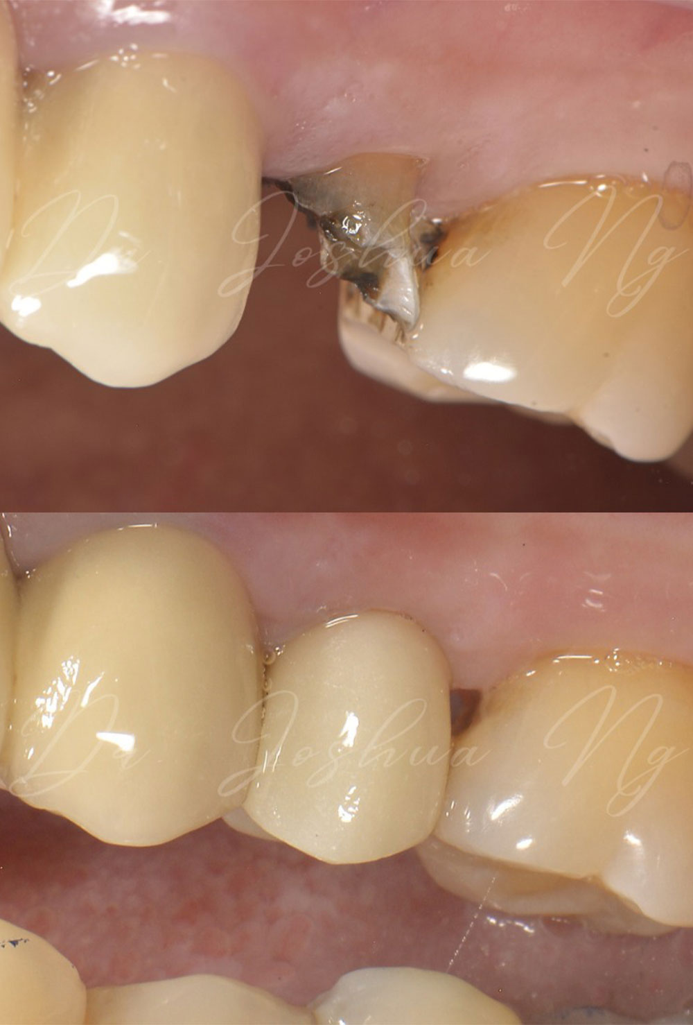 Dental Implant Before & After
