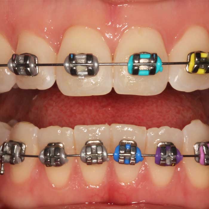 Metal Braces