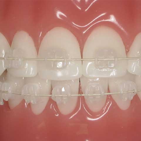 Ceramic braces